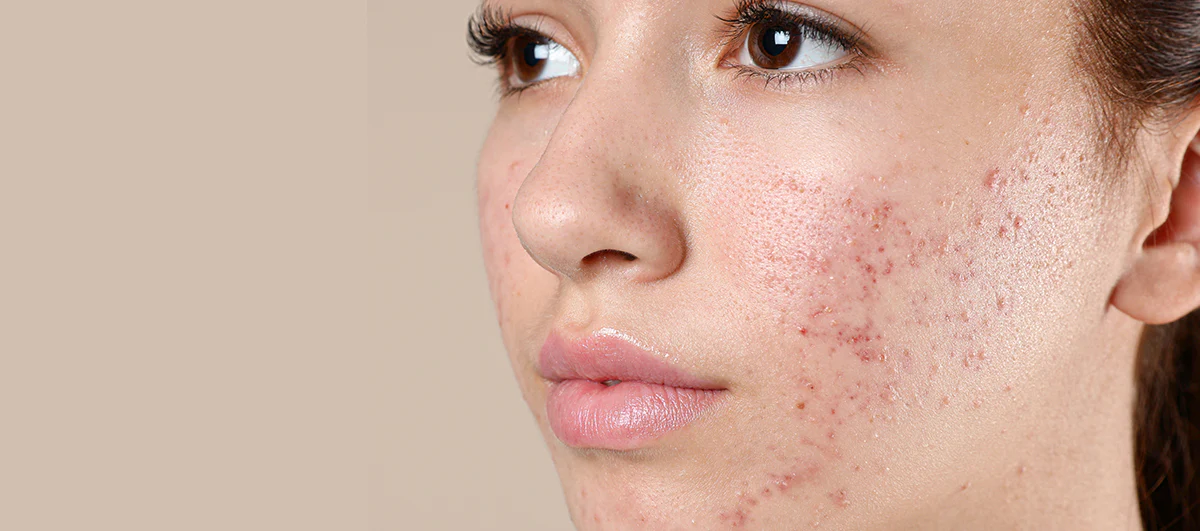 10 home remedies for oily skin.